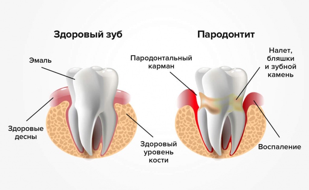 Пародонтит — не приговор!